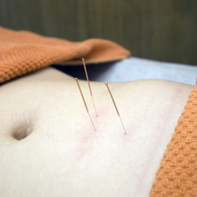 Acupuntura