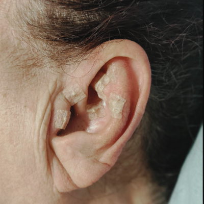 Auriculoterapia